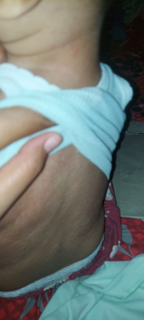 Ibu2 anak saya punggungnya sepprti ruam kasih salep apa ya bun