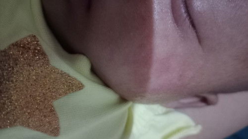 Biang keringat bruntusan merah