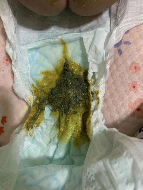 poop of baby