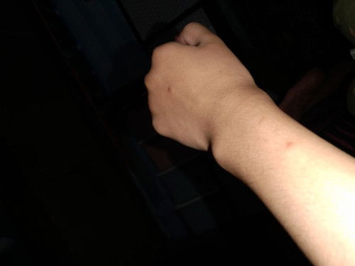 Bentol sesudah beberapa hari di infus