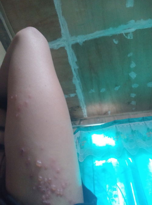 Biji berair pada kulit