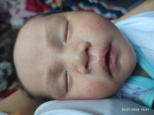 Newborn baby acne