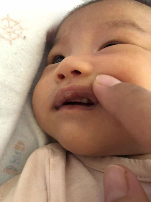 เหงือกบวมหรือฟันคะ