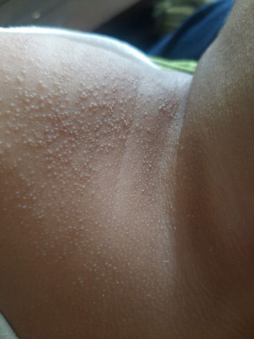 Cream untuk bayi 4 bulan di area pundak apa ya bunda bunda. Ini anak saya ada semacam bintik bintik?