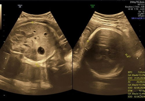 MENAIKKAN BBJ 32 WEEK