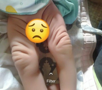 Apakah kulit anak saya wajar dan normal Bun?