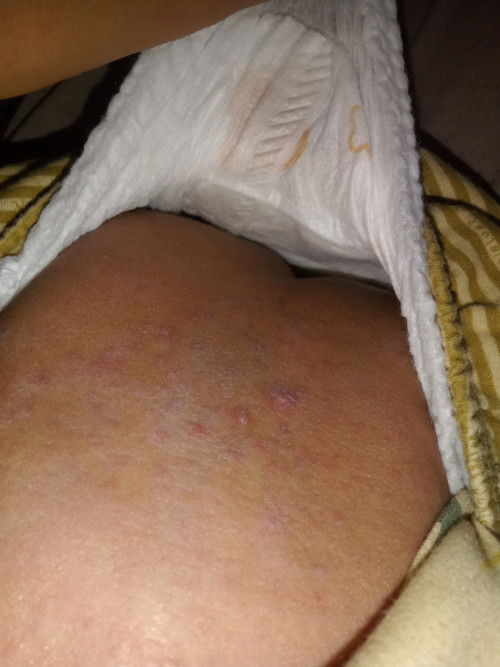 Gatal pada bayi 1 th