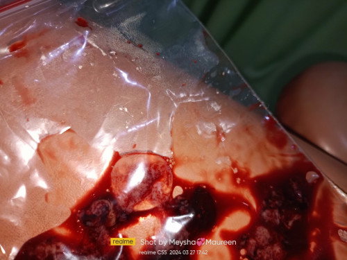 Sering kluar flek dan darah akhirnya di kuret