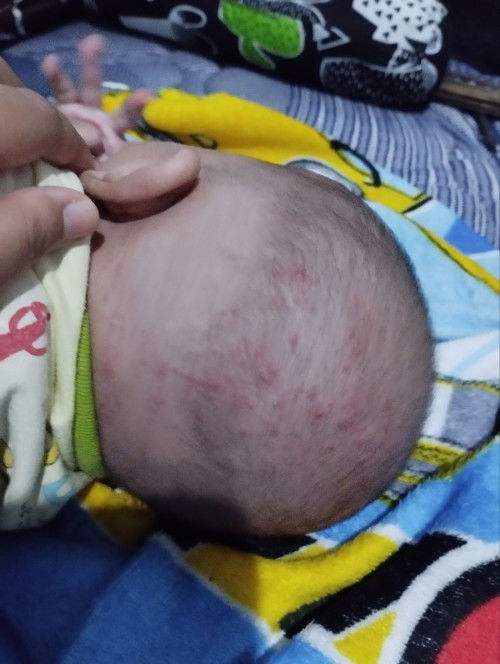 Kepala anakku ada kayak gini, apakah ini biang keringat bund ?