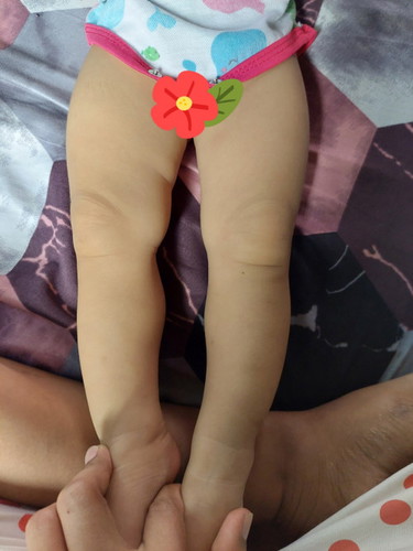 normal lang ba na ganito po ang binte ng baby? 10mos old po ang baby ko.