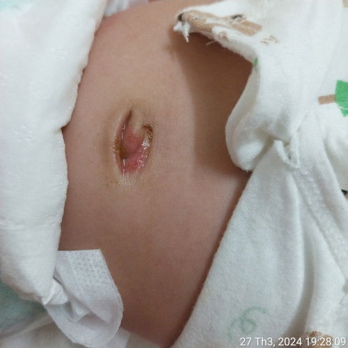 Rụng rốn ở trẻ sơ sinh