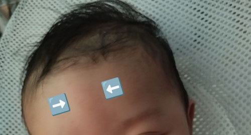 Hi. Mag 3 months baby ko, may na pansin akong pahabang lump sa noo nya. Ano po kaya ito? Salamat po.