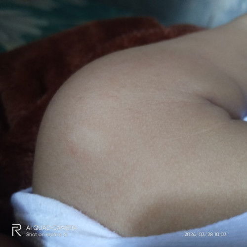 Kulit gatal bintik merah