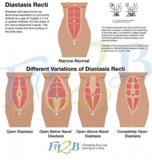 Diastasis recti