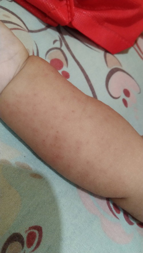 Demam dan muncul bintik-bintik merah isi air