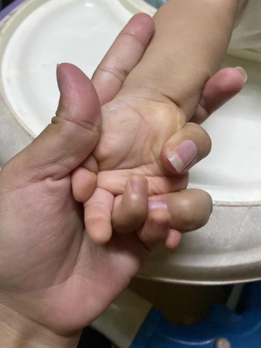 ลูก11เดือนฝ่ามือฝ่าเท้าเหลือง