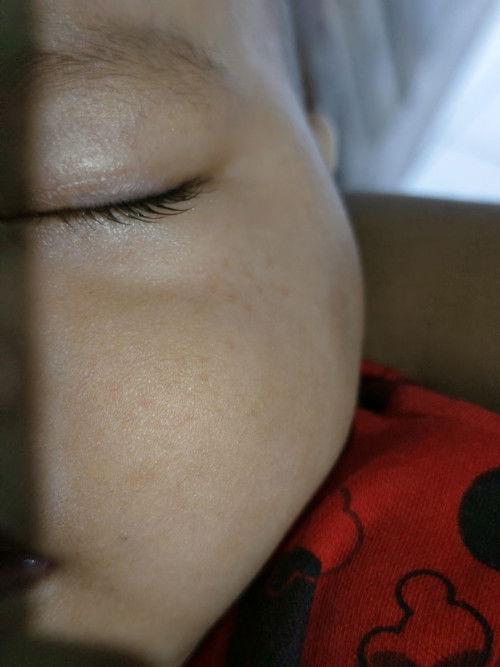 demam muncul bintik merah di pipi