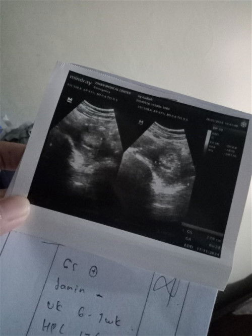 Bentuk kantung kehamilan dan flek