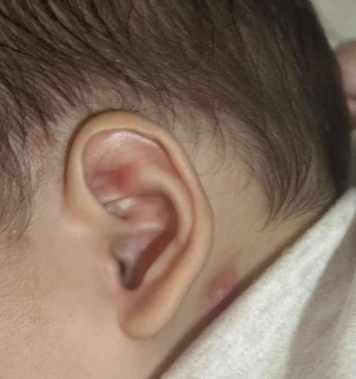 Gigitan serangga atau alergi