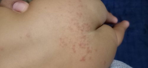 Bruntusan pada kulit bayi