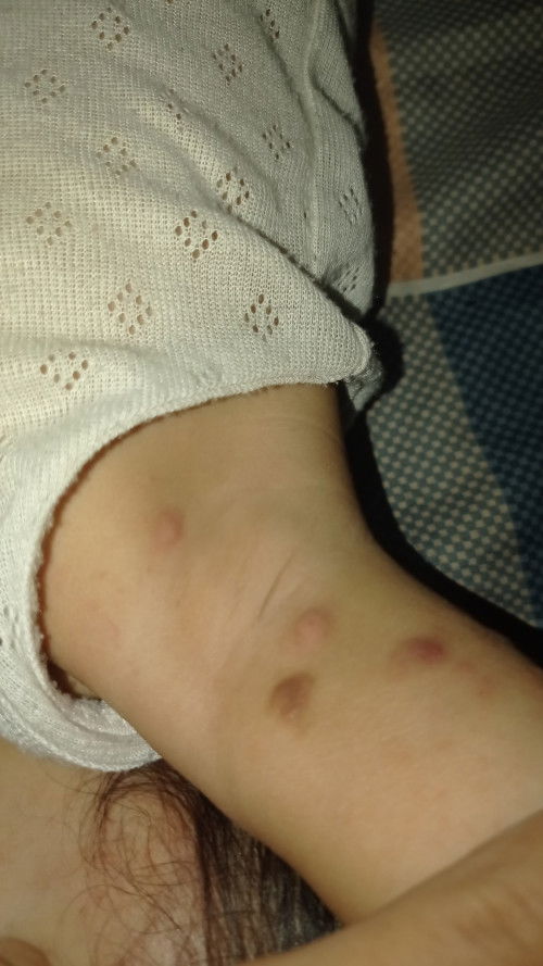 Beruntusan dan bentol berair di tubuh bayi 11 bulan