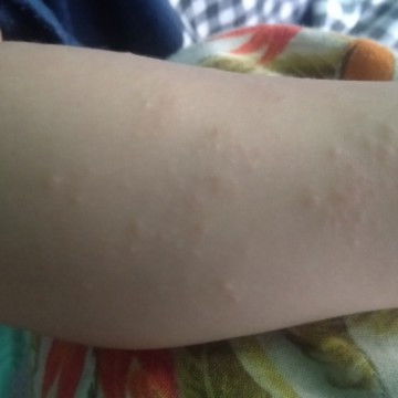 BIANG KERINGAT ATAU ALERGI