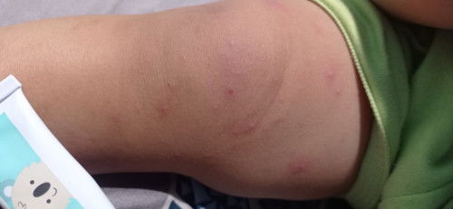 Bentol-bentol pada anak