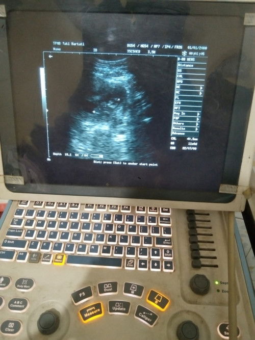 Allmdulilahh teakhir dpet mens tanggal 12 Januari. D aplikasi sama d ck bidan sama hasil ny 11minggu