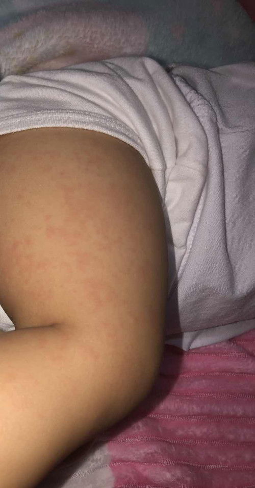 Rashes and fever