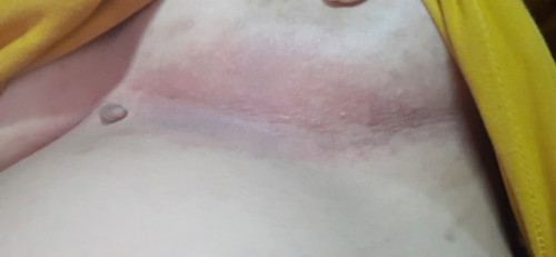 เป็นผื่นคันใต้ราวนม..สอบถามแม่ๆหน่อยค่ะ