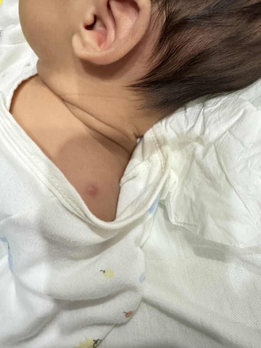 ลูกอายุ 1 เดือน ลูกเป็นเหมือนสิว หรือฝีตรงหัวไหล่ อันตรายมั้ยค่ะ ทำยังไงได้บ้าง