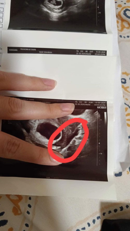 Subchorionic hematoma