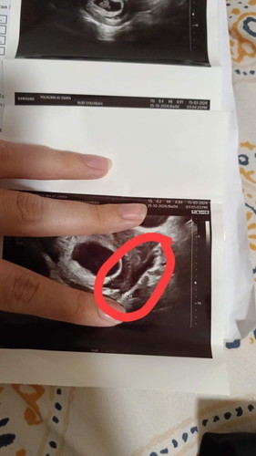 Subchorionic hematoma