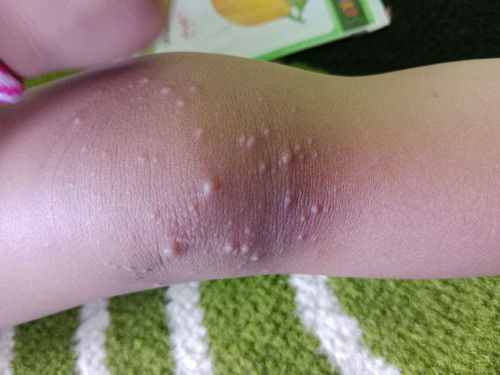 Ruam bintik di lutut anak 2 tahun