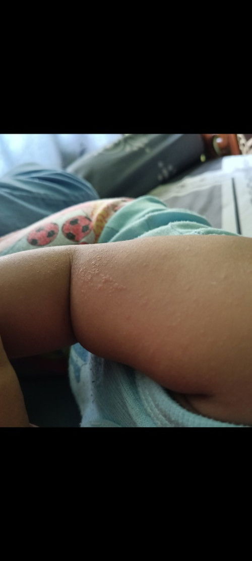 bun, ada yg tau ngga penyebab tangan anak saya gitu udah lama ngga ilang2 cara nyembuhinnya pake apa