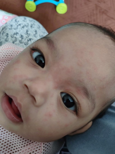 Bintik merah selepas baik demam