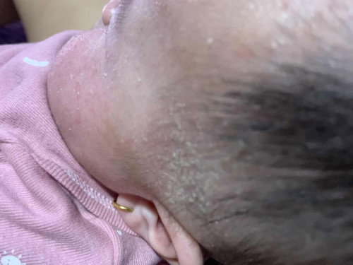Kepala bayi banyak ketombe dan pipi kering