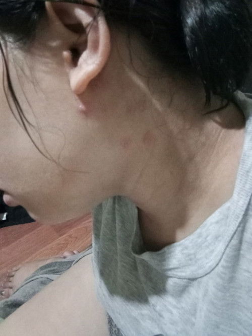 Bagong panganak po Ako ang dami ko po butlig sa leeg ano po pwede igamot?