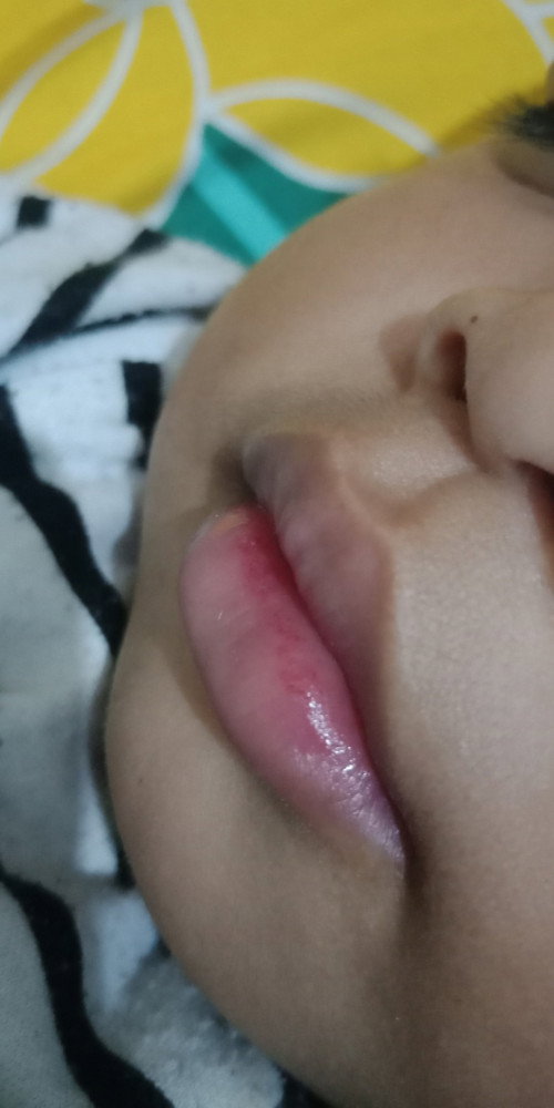 Bercak merah pada bibir anak 1 tahun