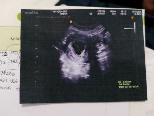 Hamil BO akhirnya vonis kuret