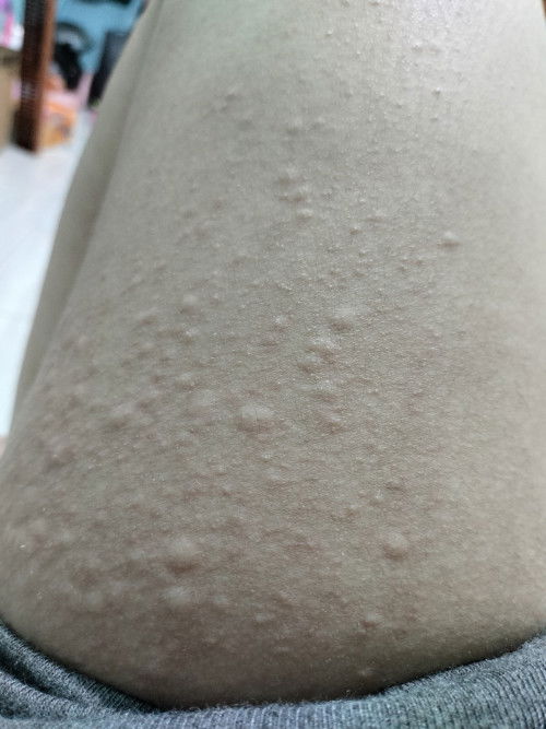 Alergi dingin dan panas (biduran)