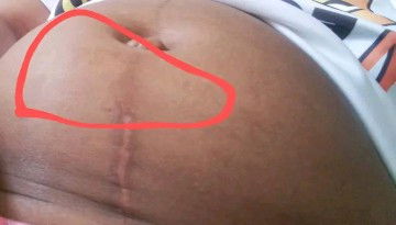 Masakit ang bandang pusod. First time CS