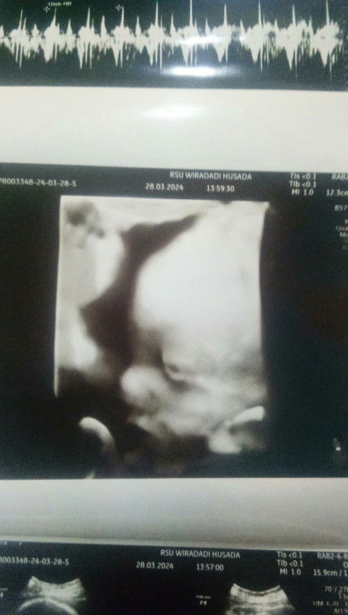 Vbac (ngikutin saran dokter apa tetep pendirian mandiri)