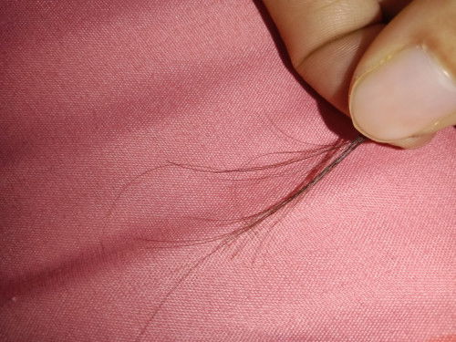 ผมร่วง ขอทราบวิธีรักษา