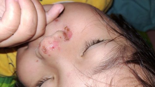 Cara menyembuhin nya pake salep apa ya bun?