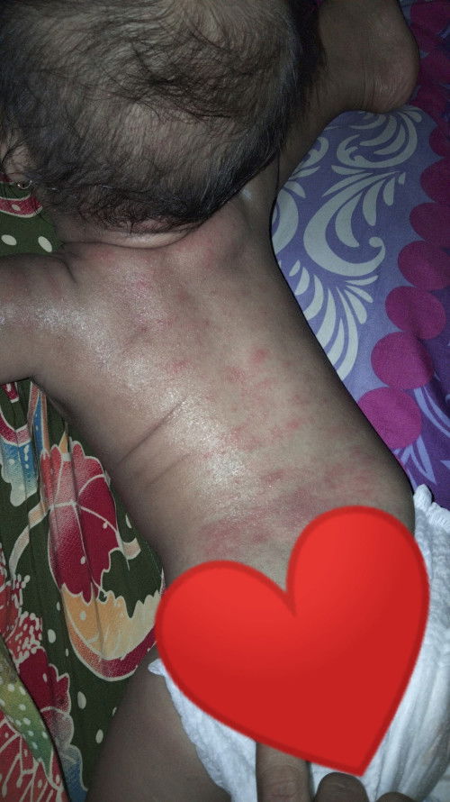 Ini campak atau ruam?karna 2hari yang lalau anakku sempat ruam dan membaik setelah pake sabun giovan