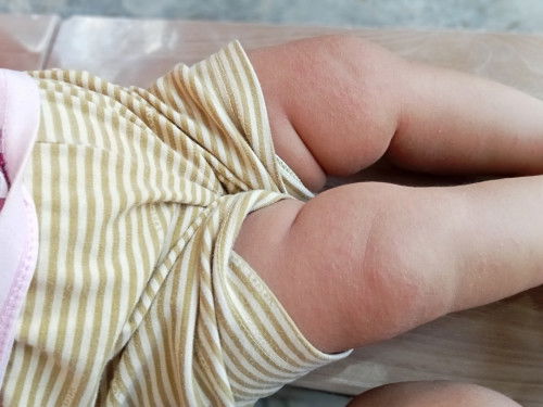 Beruntusan apa biang keringat