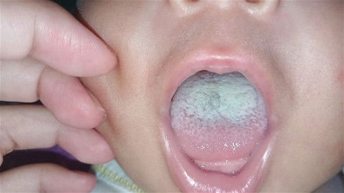 lidah bayi berwarna putih