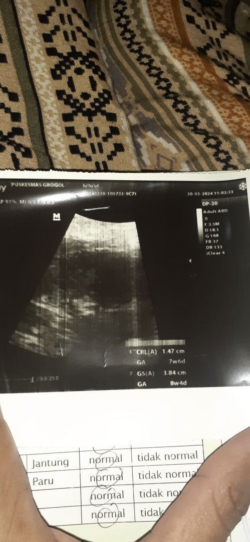 Bun adakah usia kehamilan 8 minggu blom terlihat kantong janinya??