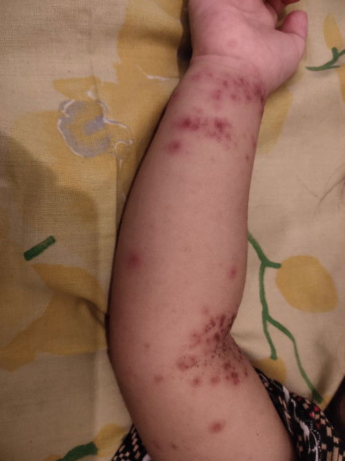 Bunda.  Biasanya berapa lama ya untuk sembuh?